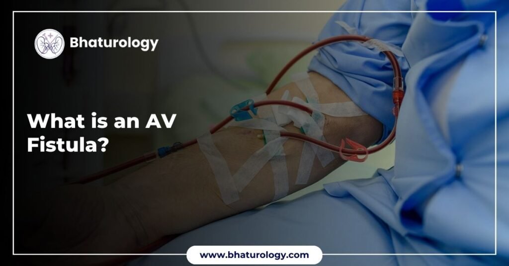 What is an AV Fistula